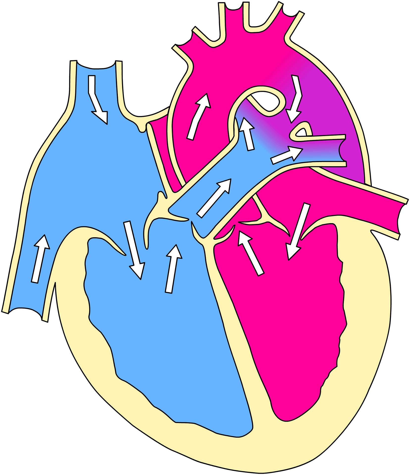 Оап у новорожденных. Врожденный порок сердца открытый артериальный проток. Порок сердца Баталов проток. Открытый артериальный проток (ОАП). Открытый боталлов проток.